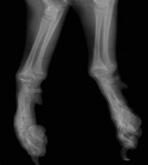 Rickets is a nutritional deficiency that hinders the proper development of bones, leading to potential fractures and deformity. Conference 21 - 2008 Case: 2 20090401