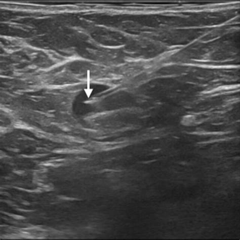 Preoperative Ultrasound Guided Wire Marking Of The Suspicious Axillary