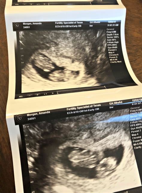 Identical Twin Pregnancy The First Trimester