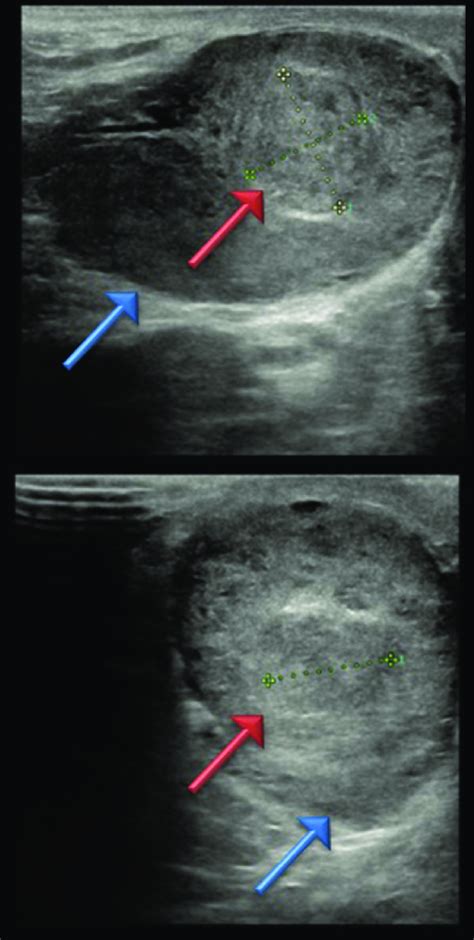 Ultrasound Of The Right Testis The Image Shows The Solid Lesion Of