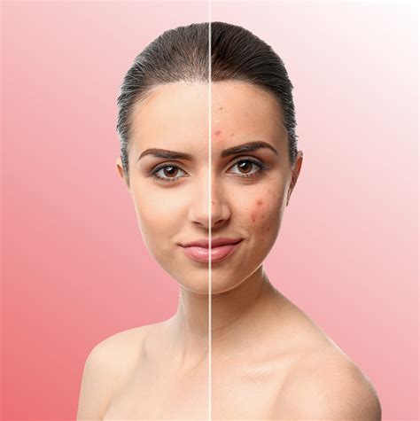 Acne Treatments Acne Specialist Pure Skin Pro