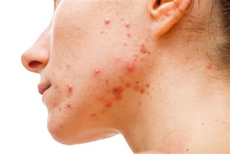 10 Possible Causes For Those Bumps On Your Skin Supernutritious
