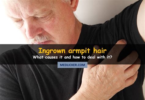Ingrown Underarm Hair Treatment Prevention And More