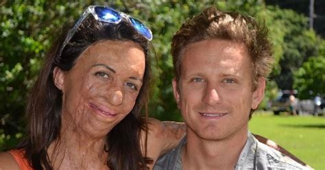 Turia Pitt Pregnant She Just Made The Announcement On Minutes