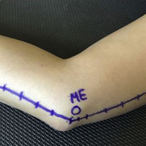 Skin Incision Marked With Identification Of The Medial Epicondyle And