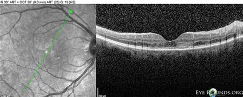 Acute Posterior Multifocal Placoid Pigment Epitheliopathy Apmppe