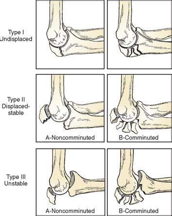 The olecranon is, in fact, the near end of the ulna, the bone in the forearm, that forms the pointed portion of the elbow. Nonunion of the Olecranon and Proximal Ulna ...