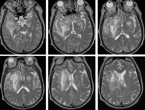 Primary Cns Lymphoma Radiology Cases