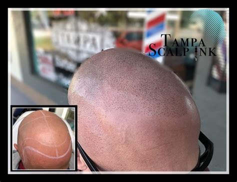 Scalp Micropigmentation Smp Tampa Smp Florida Scalp