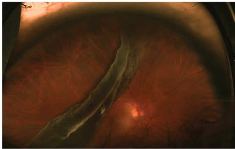 Repair Of Rd Associated With Giant Retinal Tear
