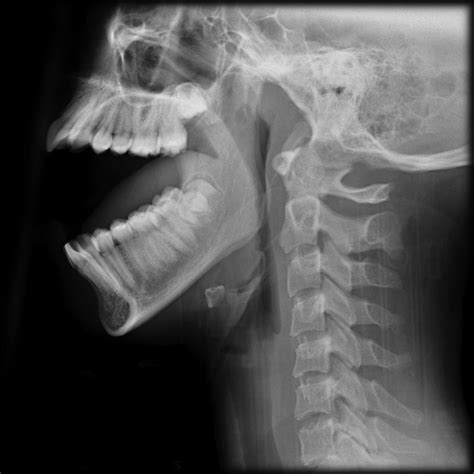 Dislocated Jaw X Ray
