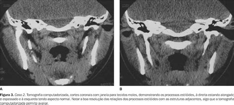 Scielo Brasil Alongamento Do Processo Estilóide Síndrome De Eagle