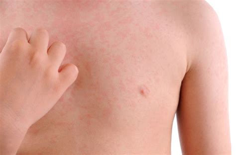 Eczema Adulte Stress Éruption Et Allergie Cutanée Réaction Et