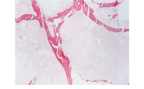 Detail Of A Trabecular Fracture At 200°c Hematoxylin Eosin 49