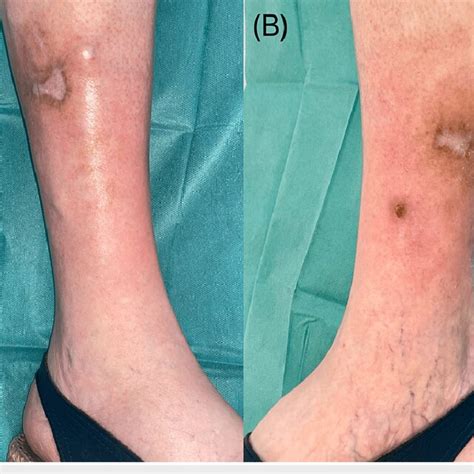 Skin Lesions Healing After Six Months Of Wound Care A Lateral Side Download Scientific