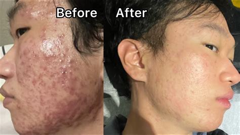 Before And After Isotretinoinaccutane For 1 Month Straight