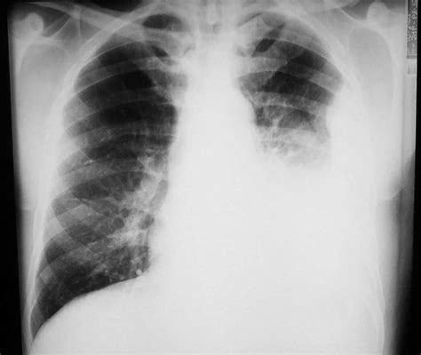 Chest X Ray Showing Left Lower Lobe Consolidation With Possible Pleural