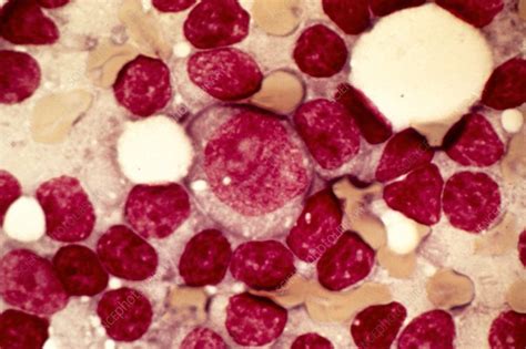 Chronic Lymphocytic Leukaemia Micrograph Stock Image C0151818