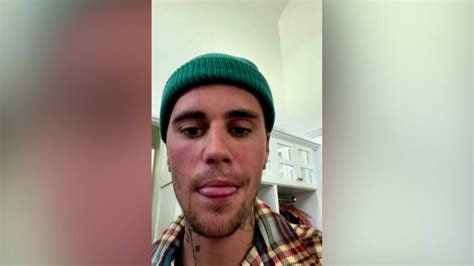 Justin Bieber Says He Has Facial Paralysis Due To Ramsay Hunt Syndrome Globalnews Ca