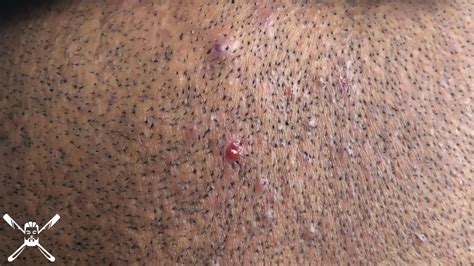 Ingrown Hair Extraction Full Clip 1 Youtube