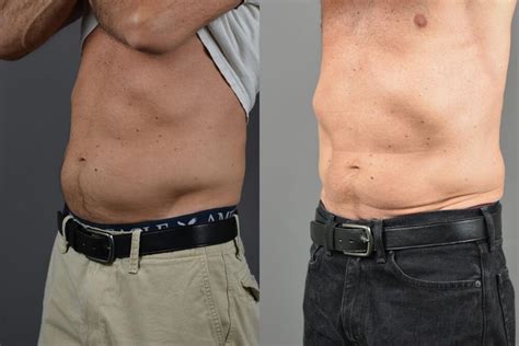 Sculpsure Before And After Patient 01 Dr Marotta