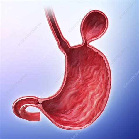 Human Stomach With Hernia Artwork Stock Image F0087046 Science
