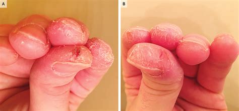 Cracked Skin Of The Fingertips Mechanics Hand Medizzy Journal