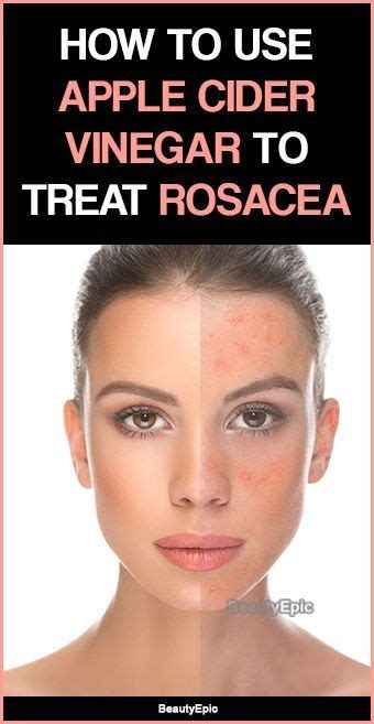 How To Use Apple Cider Vinegar To Treat Rosacea Rosacea Skin Care