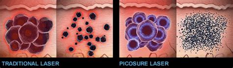 Laser energy is delivered to the tattoo, targeting the ink and breaking it down into smaller particles. Picosure Laser Singapore | Picosure Laser Price | The Chelsea Clinic
