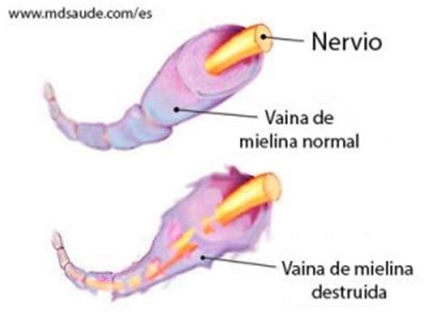 The us food and drug administration updated the label on johnson & johnson's coronavirus vaccine monday to warn of the possible increased risk of a rare neurological complication known as. Síndrome de Guillain-Barré | El blog de Sol García