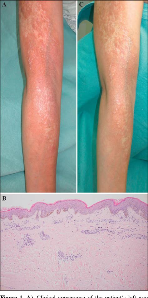 Figure 1 From Oral Tacrolimus For The Treatment Of Generalized Morphea