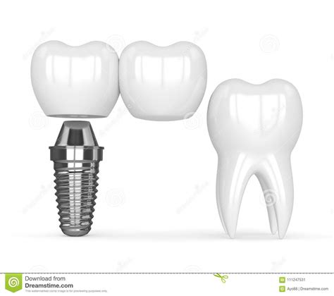 3d Render Of Implant With Dental Cantilever Bridge Stock