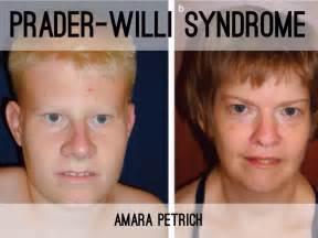 Praderwilli Syndrome Wikipedia