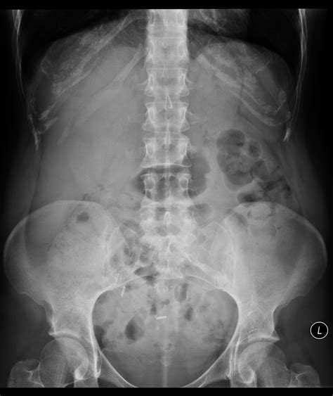 It is sometimes abbreviated to axr, or kub (for kidneys, ureters, and urinary bladder). Normal abdominal x-ray | Image | Radiopaedia.org