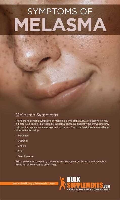 Melasma Symptoms Causes And Treatment