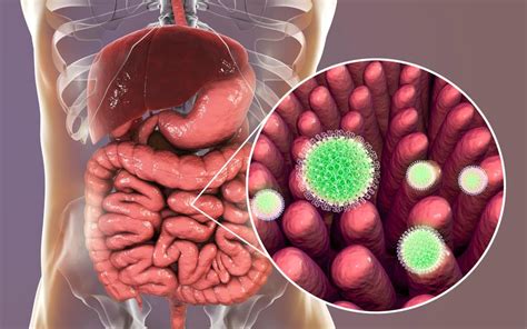 Infectia Cu Rotavirus Cauze Manifestari Si Optiuni De Tratament Dr