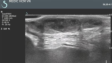 Vietnamese Medic Ultrasound Case 440 Multiple Tumors Of The Leg Dr
