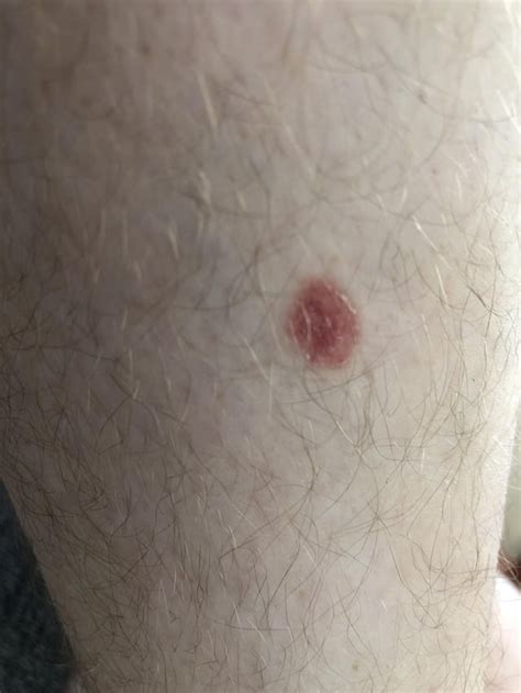 Single Red Mark On My Leg About Cm Diameter Not Itchy Or Painful Any