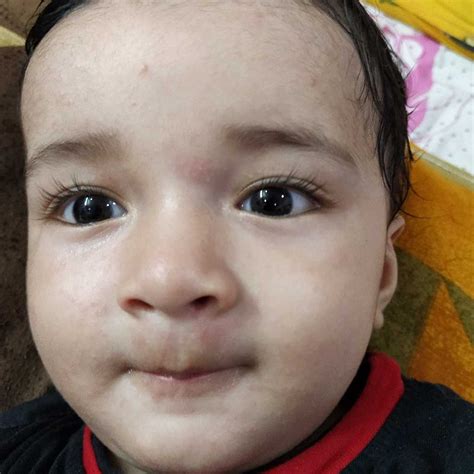 Hi My Son Is 9 Month Old From Past Few Days I Can See Rashes In
