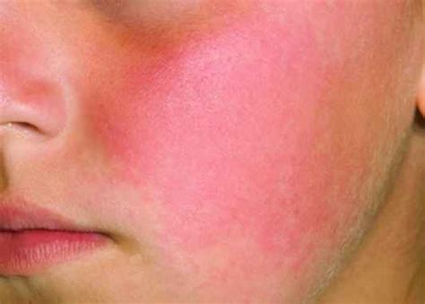 Red Blotchy Spots On Face Images And Photos Finder