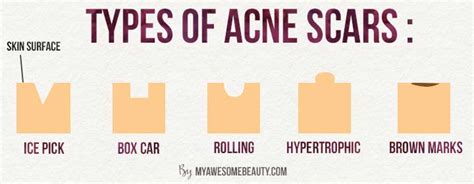 5 Types Of Acne Scars And Why You Should Care Averr Aglow Skincare