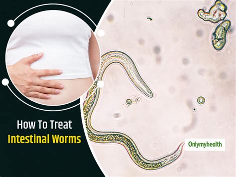 Intestinal Worms Causes Symptoms And Prevention Tips Onlymyhealth