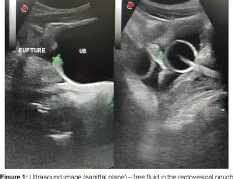 Figure 1 From Intraperitoneal Urinary Bladder Rupture Diagnosed With