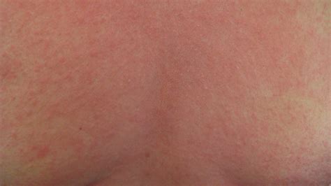 What Is A Menopause Rash