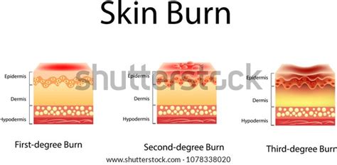 Skin Burn Three Degrees Burns Type Stock Vector Royalty Free 1078338020