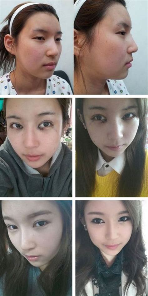 Crazy Before And After Photos Of Korean Plastic Surgery Korean Plastic Surgery South