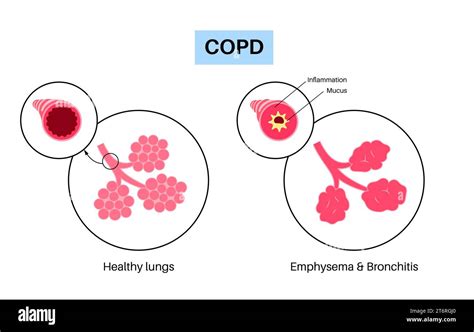 Chronic Obstructive Pulmonary Disease Illustration Stock Photo Alamy