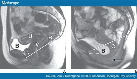 Mri Of The Urethra In Women With Lower Urinary Tract Symptoms