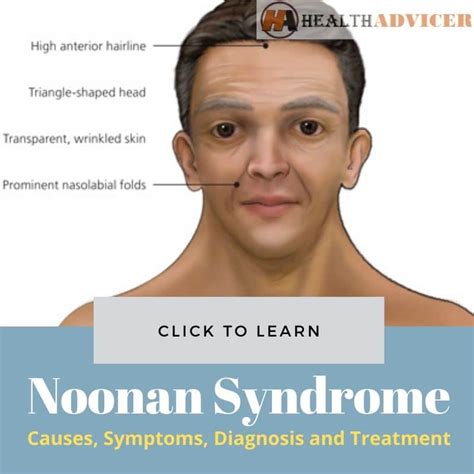 Noonan Syndrome Causes Symptoms Treatment Noonan Syndrome My Xxx Hot Girl