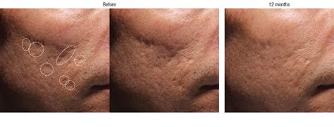 Bellafill Acne Scar Treatment Before And Afters Total Dermatology